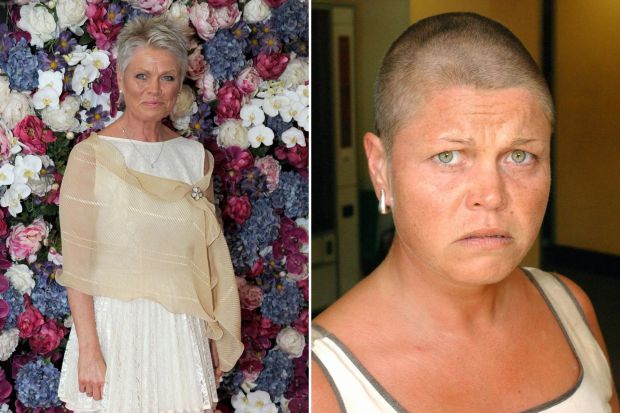 Diptych showing a woman before and after hair loss.